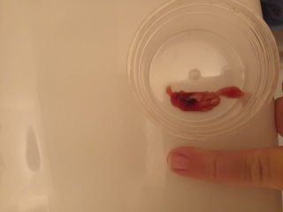 TW - graphic pictures. Post Menopause bleeding and clots. Any advice gratefully received! 
