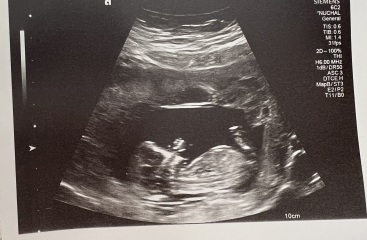High nuchal scan and CVS test