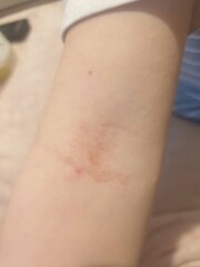 Does anyone know what this is on child's arm and hands