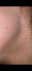 Awful facial excess hair pregnancy symptoms:(