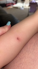 Infected bite? 
