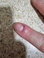 I am going to lose my nail?