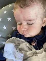 Adult Chickenpox & 6 months old baby