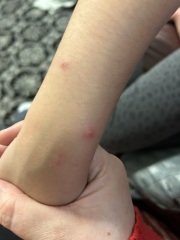 Chicken pox