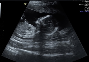 First cycle - IVF / ICSI - Day 4 