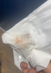 Is my line getting weaker? Just had light pink spotting after bowel movement - cervical ectropion 