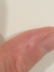 Is this what happens to warts?