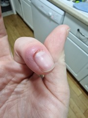 I am going to lose my nail?