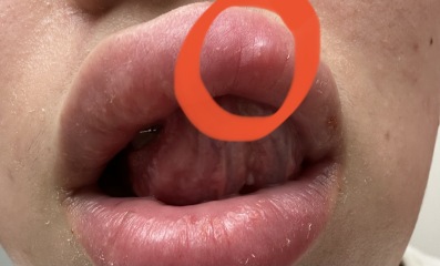 White bump for a year now