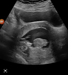 12 weeks 1 day!! Can anyone see the nub???