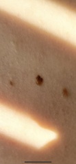 Dodgy mole