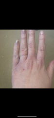 Sorry horrible toe pic but anyone with Psoriatic Arthritis can you help
