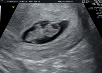 Terrified for my 8 week scan 
