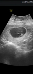 Can the yolk sac move?