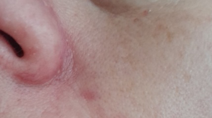 Why is my chin and nose so red