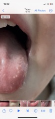 Hand foot and mouth?