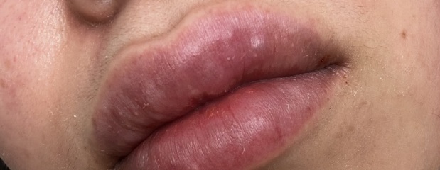 White bump for a year now