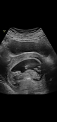 Baby movements? 3rd pregnancy