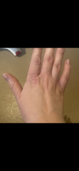Sorry horrible toe pic but anyone with Psoriatic Arthritis can you help