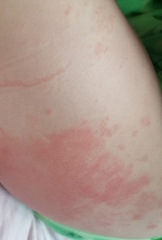 Private dermatologist for DC reccomendations. Pics attached 