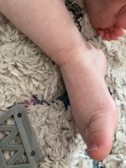 Is this hand foot & mouth?