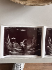 Nub theory - guess my baby's gender!
