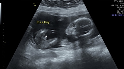 First cycle - IVF / ICSI - Day 4 
