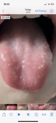 Hand foot and mouth?