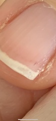 Black marks on nails