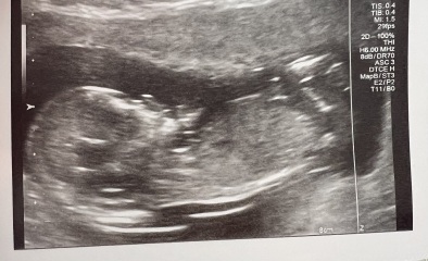 High nuchal scan and CVS test