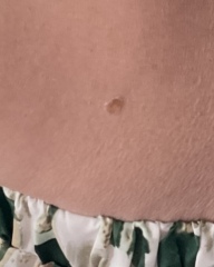 Could this be melanoma?