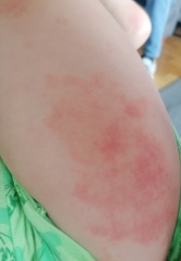 Private dermatologist for DC reccomendations. Pics attached 