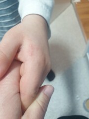 Does anyone know what this is on child's arm and hands
