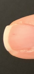 Black marks on nails