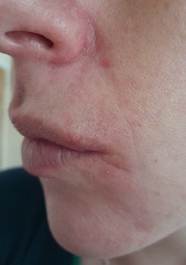 Why is my chin and nose so red