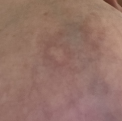 White patch on boob