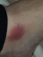 What has bitten me?  Photos