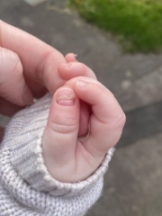 Baby finger nail coming off 