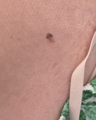 Could this be melanoma?