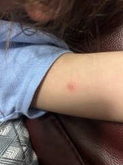 Chicken pox
