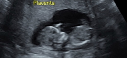 12 weeks! Potty shot and nub guesses?