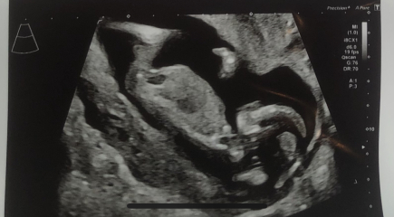 Tricky dating scan! Any guesses on the gender please?