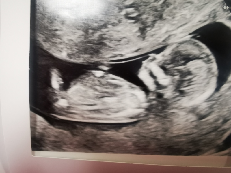12 week scan at 8:40 am today - feeling very anxious!! 
