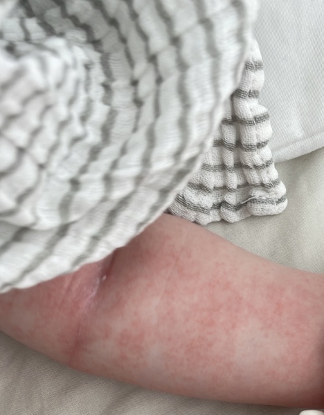 Eczema? Hormonal? CMPA? 