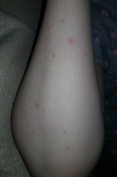 Insect bites