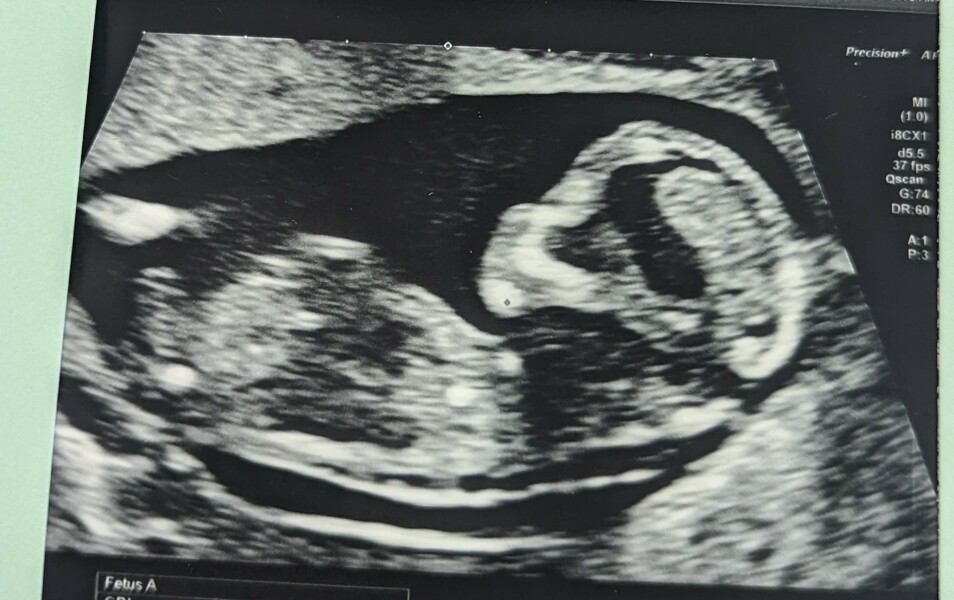 Nub theory - boy or girl, what's your prediction?!