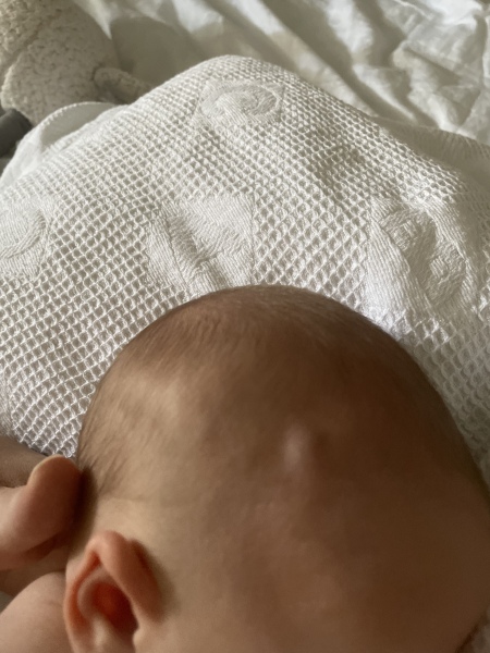 To vitamin K or not to Vitamin K…