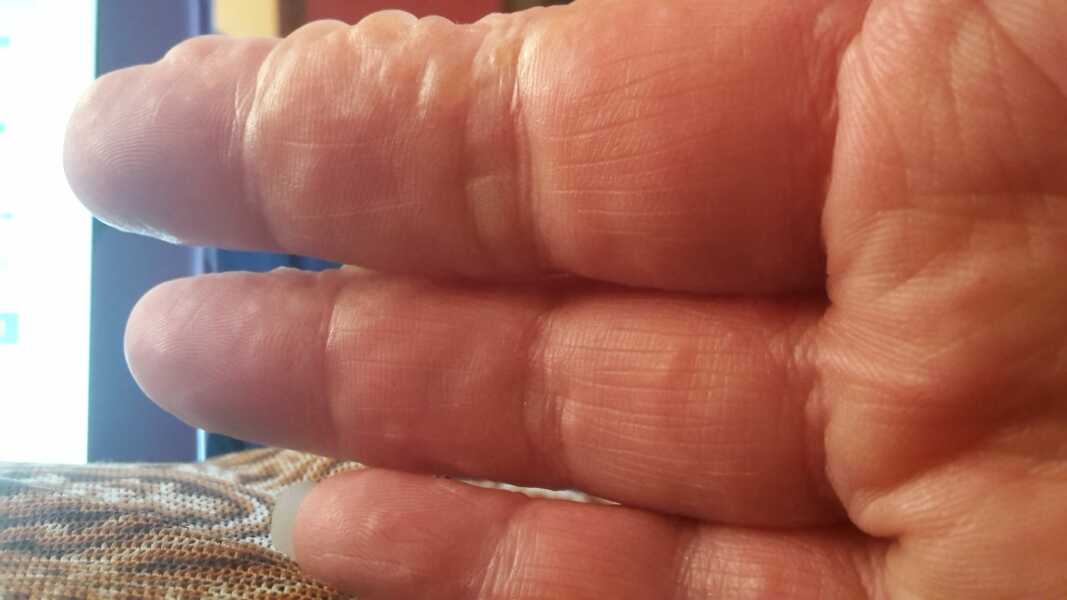 Pompholyx eczema 
