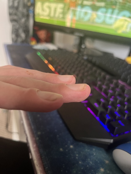Hand and fingers all weird looking after broken wrist