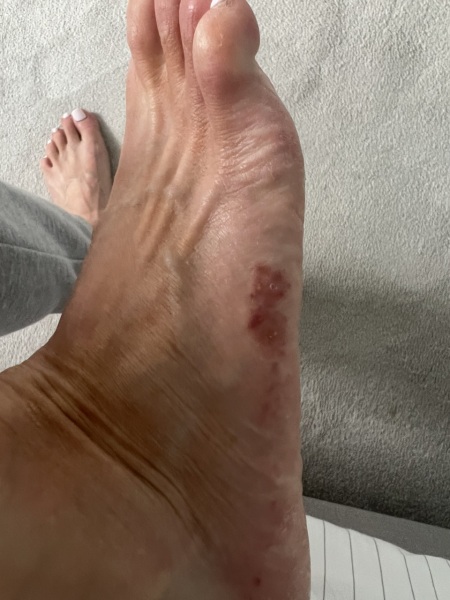 Rank red patches on foot